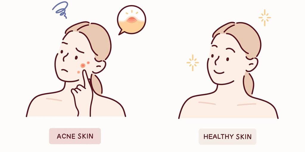 Best Acne-Fighting Ingredients: Your Guide to Clearer Skin